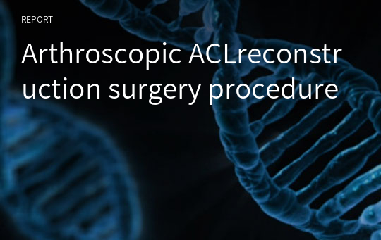 Arthroscopic ACLreconstruction surgery procedure