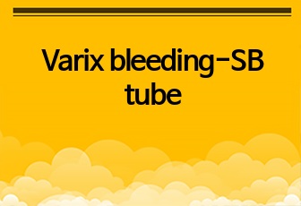 Varix bleeding-SB tube